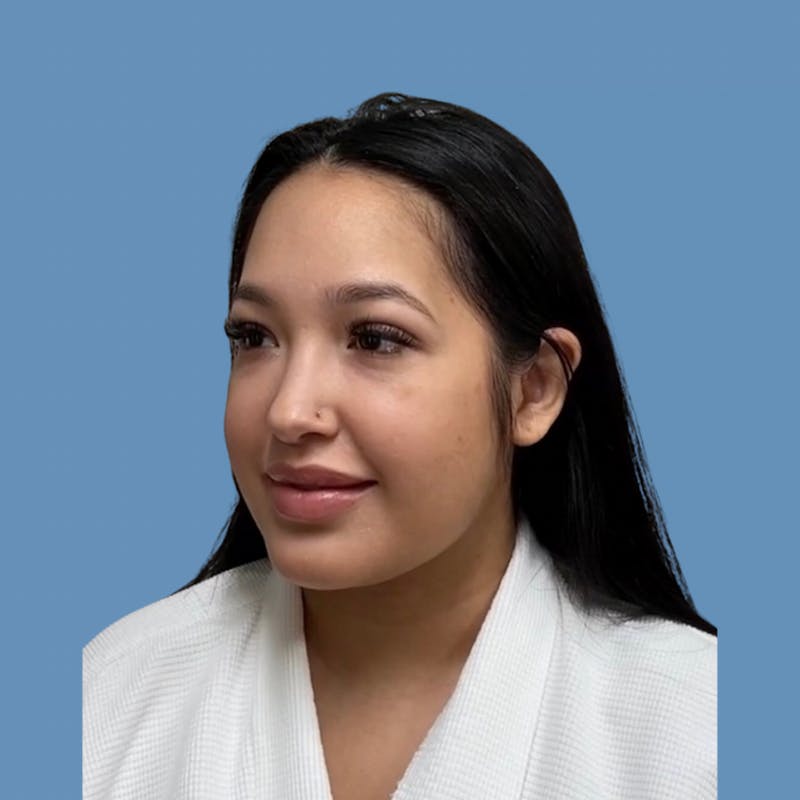 FaceTite / NeckTite Before & After Gallery - Patient 275300 - Image 2