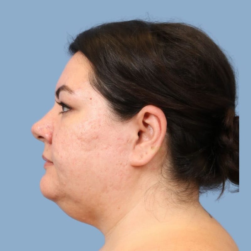 FaceTite / NeckTite Before & After Gallery - Patient 418134 - Image 1