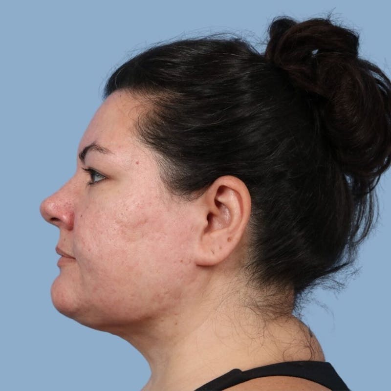 FaceTite / NeckTite Before & After Gallery - Patient 418134 - Image 2