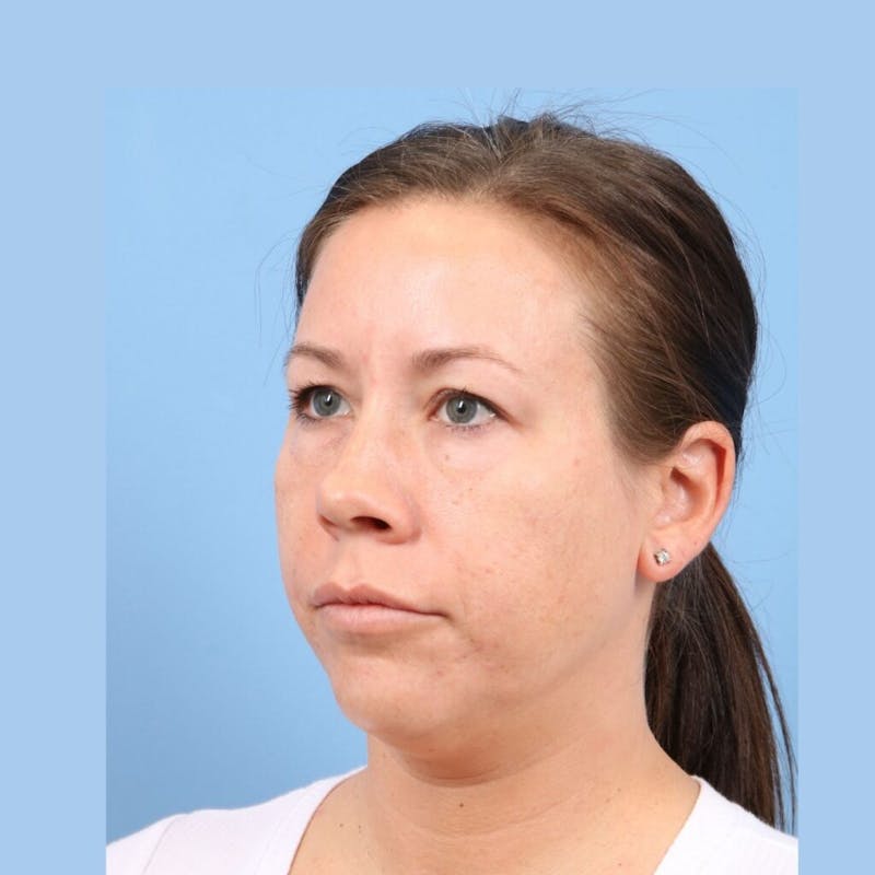 FaceTite / NeckTite Before & After Gallery - Patient 223806 - Image 3