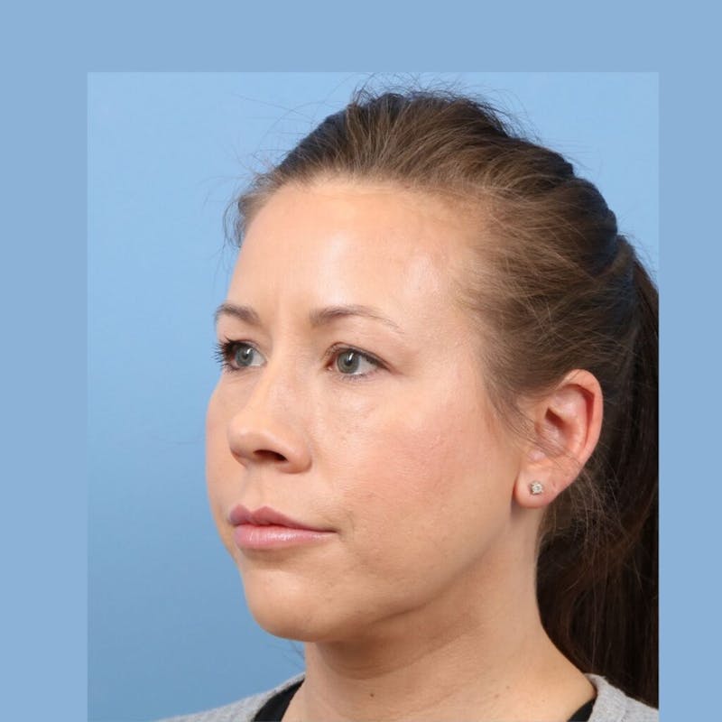 FaceTite / NeckTite Before & After Gallery - Patient 223806 - Image 4