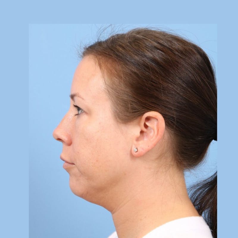 FaceTite / NeckTite Before & After Gallery - Patient 223806 - Image 1