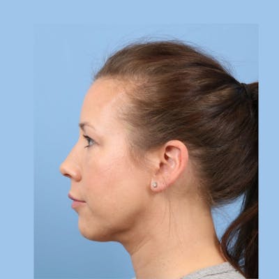 FaceTite / NeckTite Before & After Gallery - Patient 223806 - Image 2