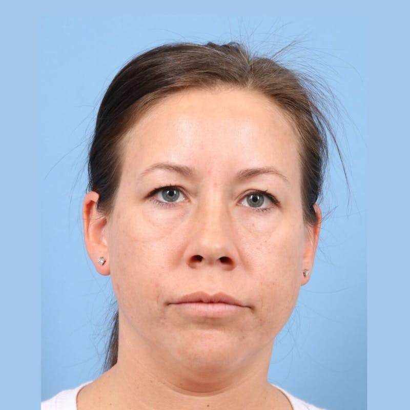 FaceTite / NeckTite Before & After Gallery - Patient 223806 - Image 5