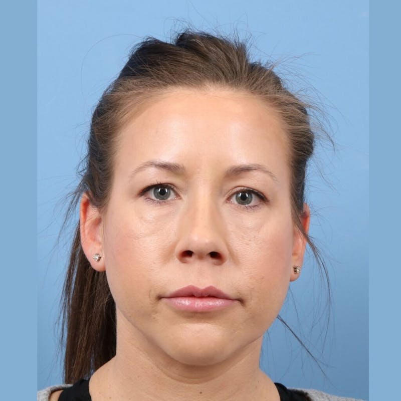 FaceTite / NeckTite Before & After Gallery - Patient 223806 - Image 6