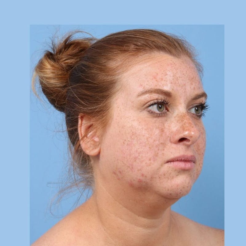 FaceTite / NeckTite Before & After Gallery - Patient 705548 - Image 3