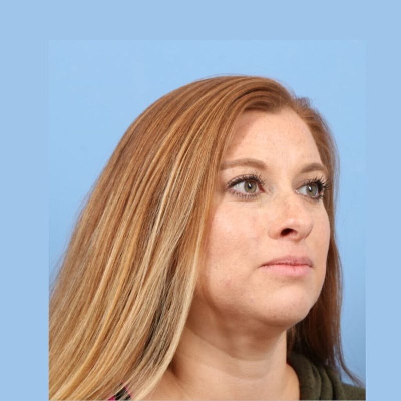 FaceTite / NeckTite Before & After Gallery - Patient 705548 - Image 4