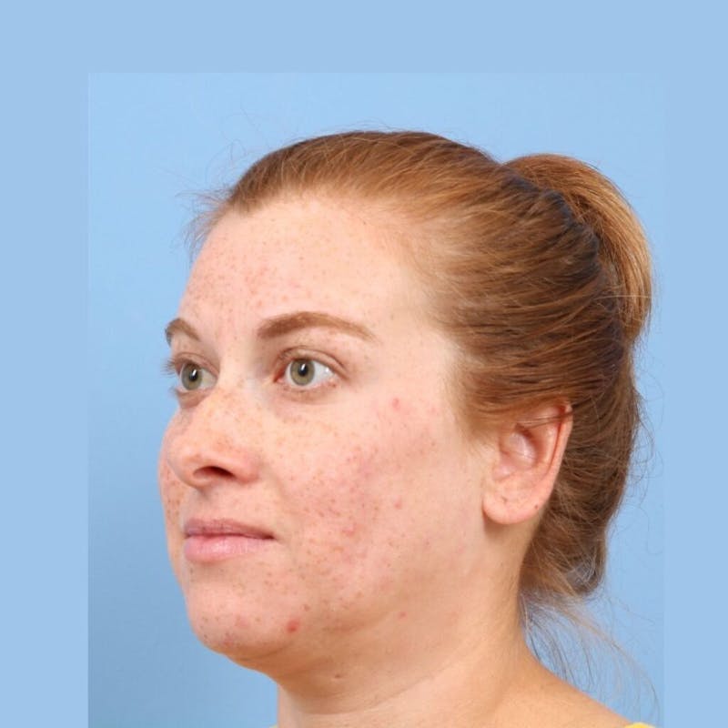 FaceTite / NeckTite Before & After Gallery - Patient 705548 - Image 5