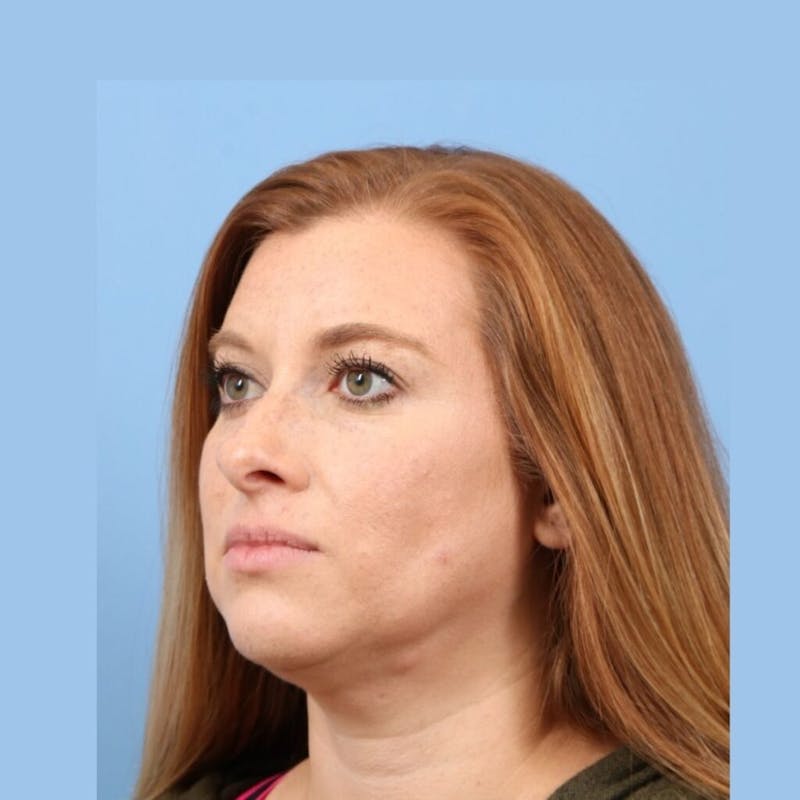 FaceTite / NeckTite Before & After Gallery - Patient 705548 - Image 6