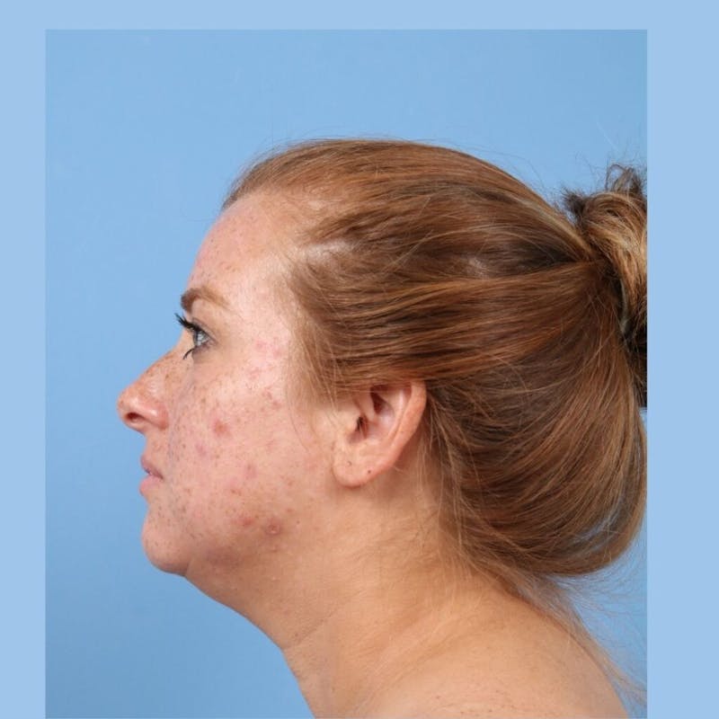 FaceTite / NeckTite Before & After Gallery - Patient 705548 - Image 1