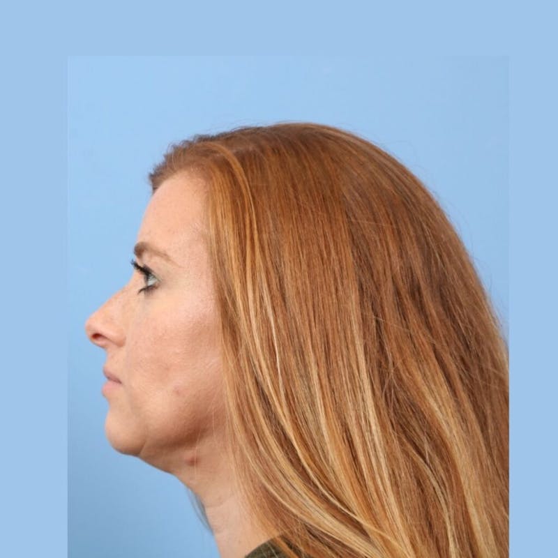 FaceTite / NeckTite Before & After Gallery - Patient 705548 - Image 2