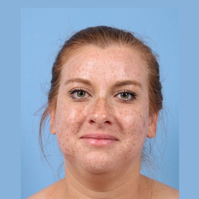 FaceTite / NeckTite Before & After Gallery - Patient 705548 - Image 7