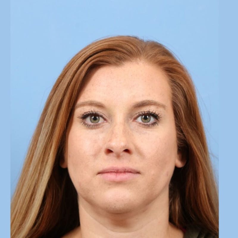 FaceTite / NeckTite Before & After Gallery - Patient 705548 - Image 8