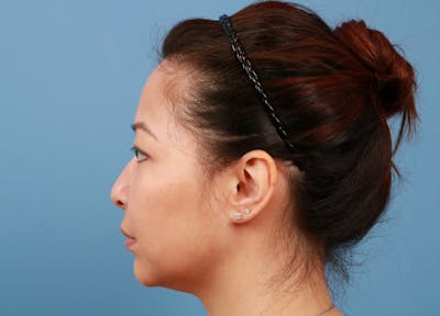 FaceTite / NeckTite Before & After Gallery - Patient 231216 - Image 1