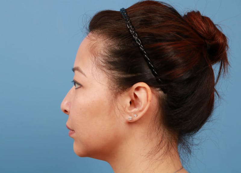 FaceTite / NeckTite Before & After Gallery - Patient 231216 - Image 1