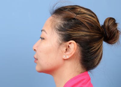 FaceTite / NeckTite Before & After Gallery - Patient 231216 - Image 2