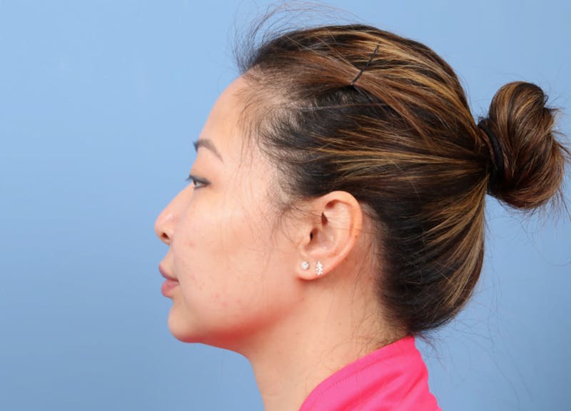 FaceTite / NeckTite Before & After Gallery - Patient 231216 - Image 2