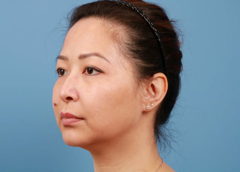 FaceTite / NeckTite Before & After Gallery - Patient 231216 - Image 5