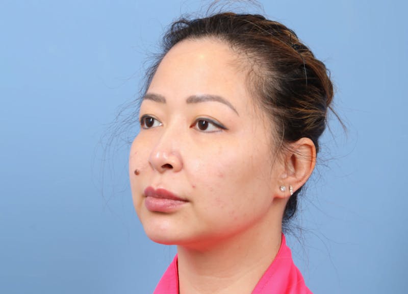 FaceTite / NeckTite Before & After Gallery - Patient 231216 - Image 6