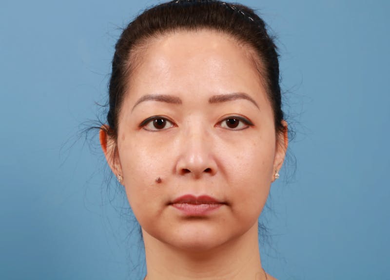 FaceTite / NeckTite Before & After Gallery - Patient 231216 - Image 7