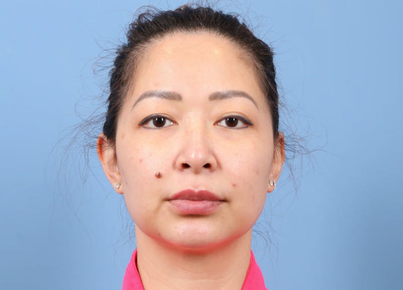 FaceTite / NeckTite Before & After Gallery - Patient 231216 - Image 8