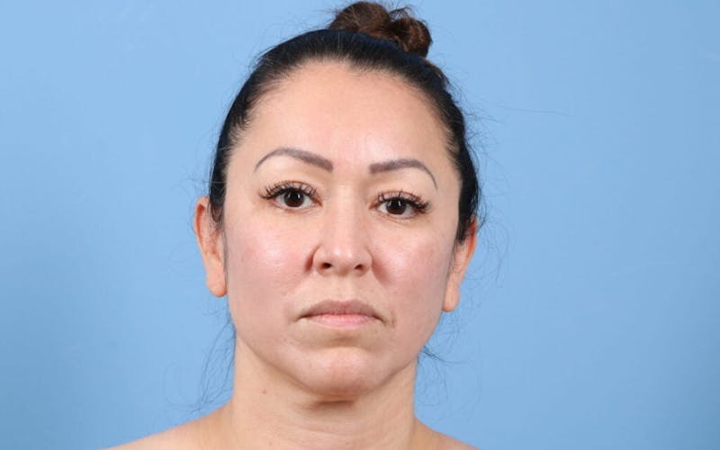 FaceTite / NeckTite Before & After Gallery - Patient 924143 - Image 3