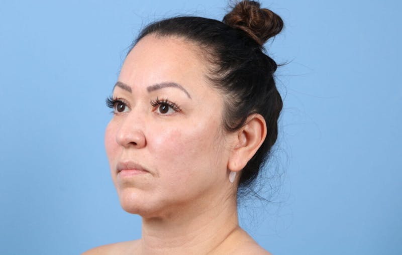 FaceTite / NeckTite Before & After Gallery - Patient 924143 - Image 5
