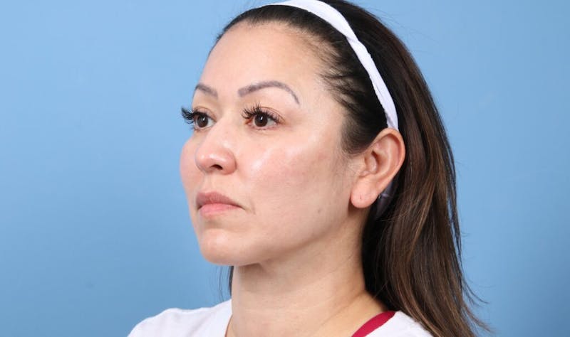 FaceTite / NeckTite Before & After Gallery - Patient 924143 - Image 6