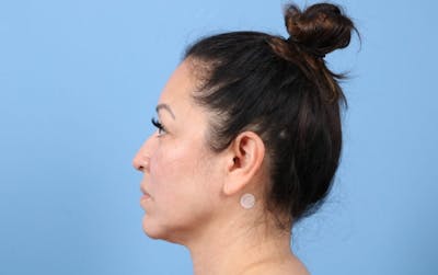 FaceTite / NeckTite Before & After Gallery - Patient 924143 - Image 1