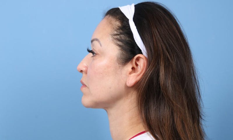 FaceTite / NeckTite Before & After Gallery - Patient 924143 - Image 2
