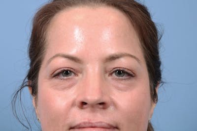 Eyelid Surgery Before & After Gallery - Patient 602617 - Image 1