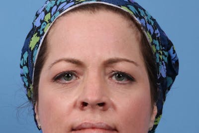 Eyelid Surgery Before & After Gallery - Patient 602617 - Image 2