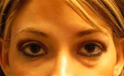 Eyelid Surgery Before & After Gallery - Patient 124452 - Image 1