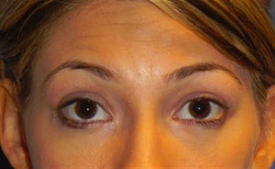 Eyelid Surgery Before & After Gallery - Patient 124452 - Image 2