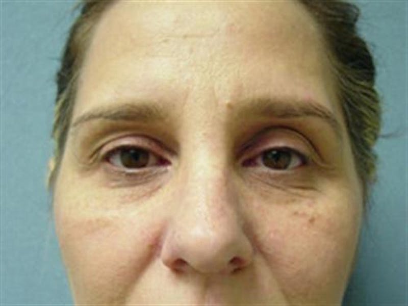 Eyelid Surgery Before & After Gallery - Patient 202865 - Image 1