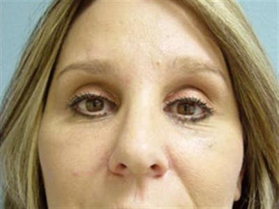Eyelid Surgery Before & After Gallery - Patient 202865 - Image 2