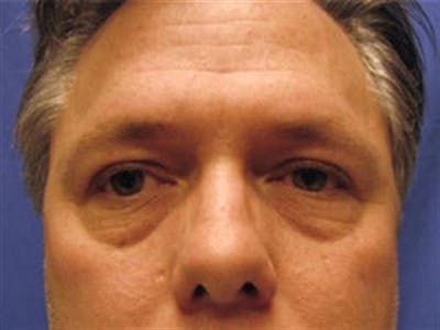 Eyelid Surgery Before & After Gallery - Patient 359699 - Image 1