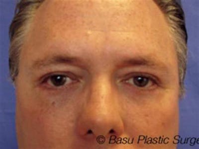 Eyelid Surgery Before & After Gallery - Patient 359699 - Image 2