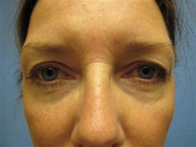 Eyelid Surgery Before & After Gallery - Patient 511317 - Image 1