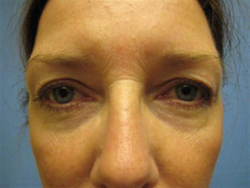 Eyelid Surgery Before & After Gallery - Patient 511317 - Image 1