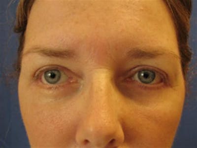 Eyelid Surgery Before & After Gallery - Patient 511317 - Image 2