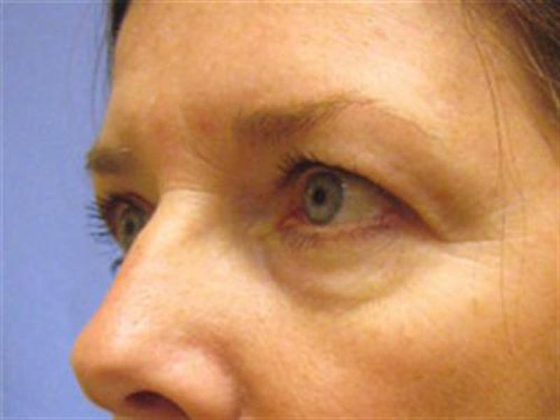 Eyelid Surgery Before & After Gallery - Patient 511317 - Image 3