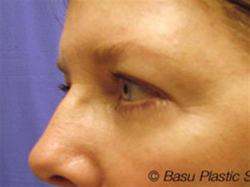 Eyelid Surgery Before & After Gallery - Patient 511317 - Image 4