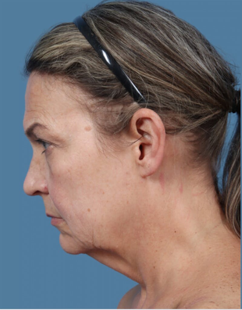 Neck Lift Before & After Gallery - Patient 348404 - Image 3