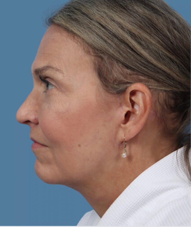 Neck Lift Before & After Gallery - Patient 348404 - Image 4