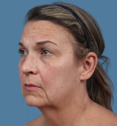 Neck Lift Before & After Gallery - Patient 348404 - Image 1