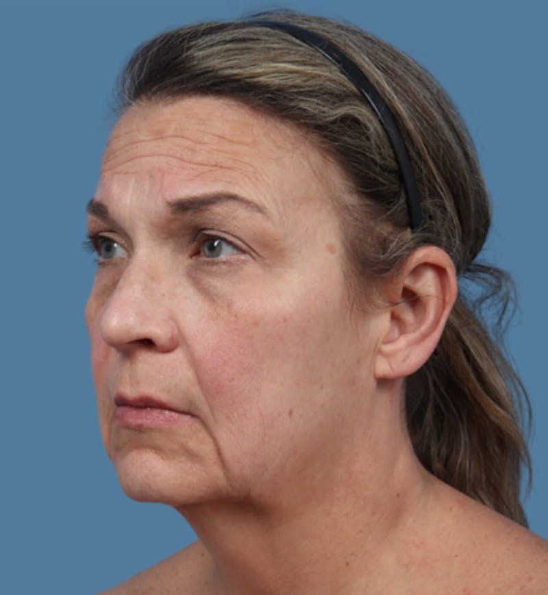 Neck Lift Before & After Gallery - Patient 348404 - Image 1