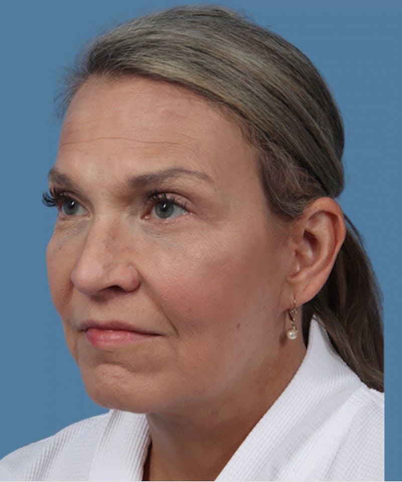 Neck Lift Before & After Gallery - Patient 348404 - Image 2