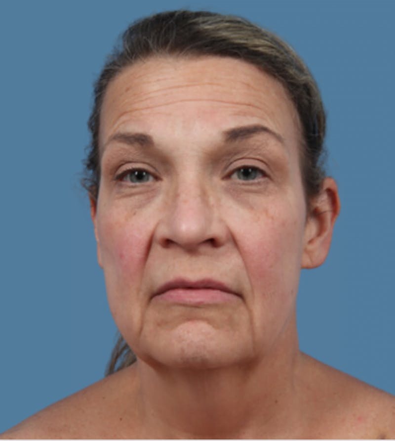 Neck Lift Before & After Gallery - Patient 348404 - Image 5