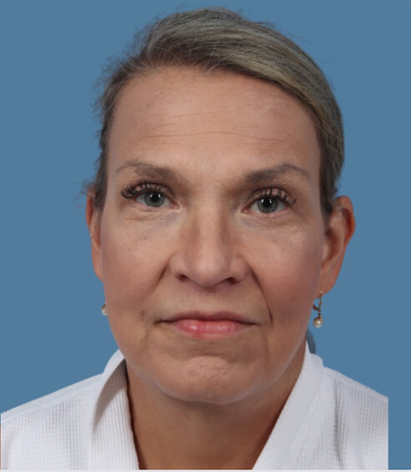 Neck Lift Before & After Gallery - Patient 348404 - Image 6
